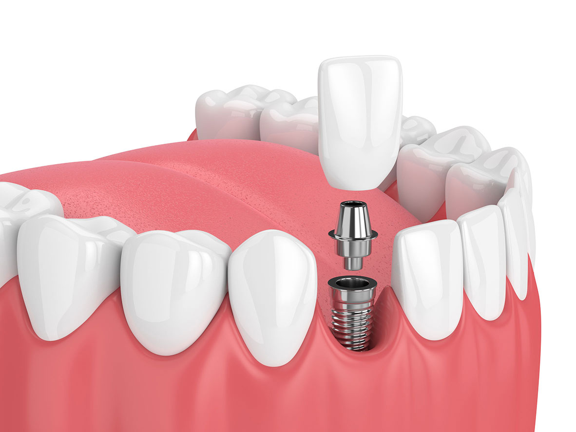 centre-dentaire-lancy-Implants-dentaires2