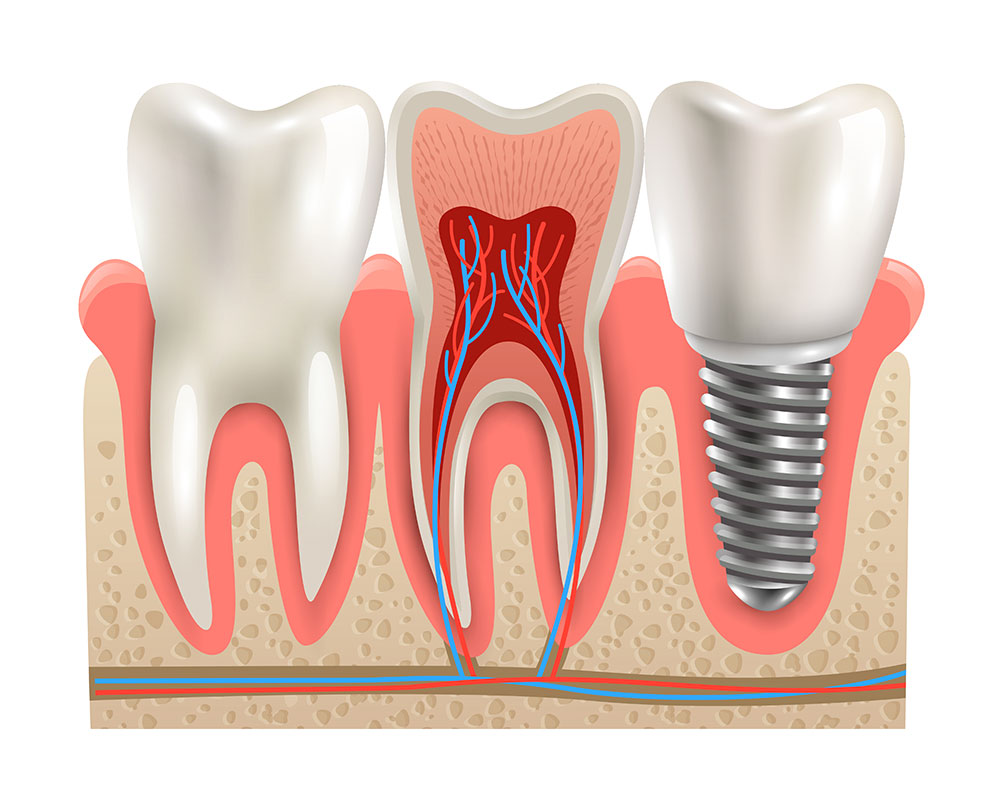 implant-dentaire-geneve